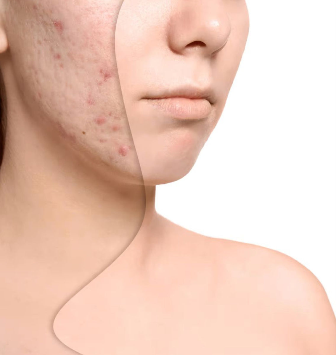 Acne Marks vs Acne Scars