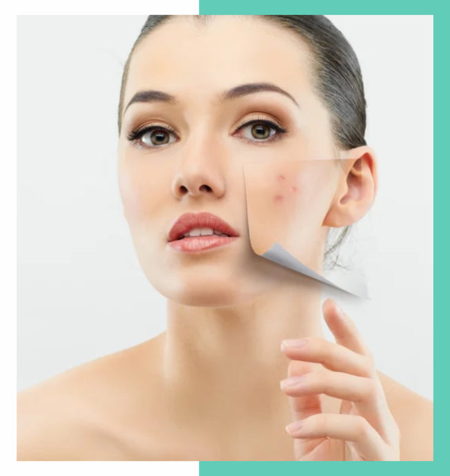Control Over Acne with Total Confidence